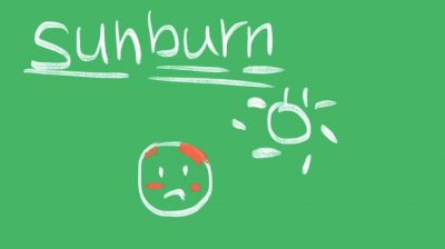 ​sunburn是什么意思